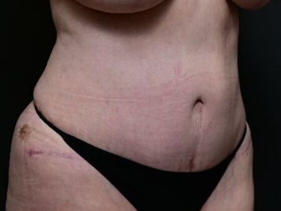 Tummy Tuck with Contouring: Case 3 - After