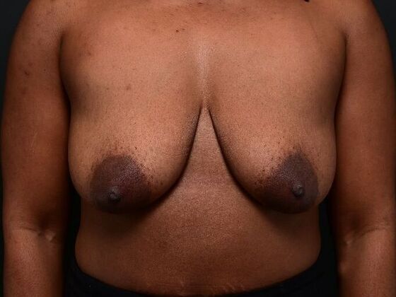 Breast Reconstruction: Case 2 - Before