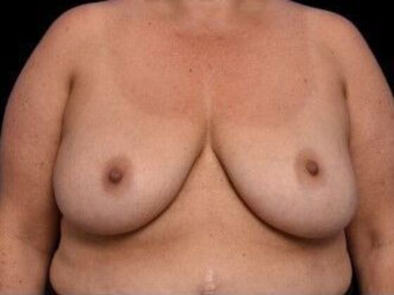 Breast Reconstruction: Case 3 - After