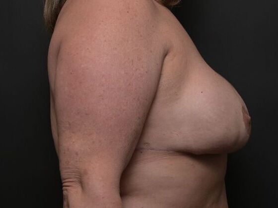 Breast Reconstruction: Case 3 - After