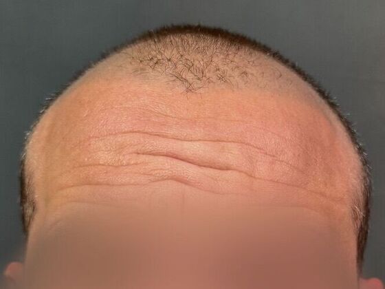 FUE Hair Restoration: Case 42 - Before