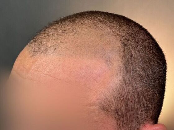 FUE Hair Restoration: Case 42 - Before