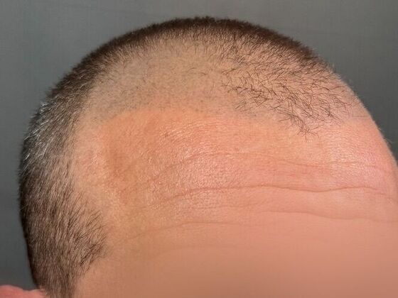 FUE Hair Restoration: Case 42 - Before