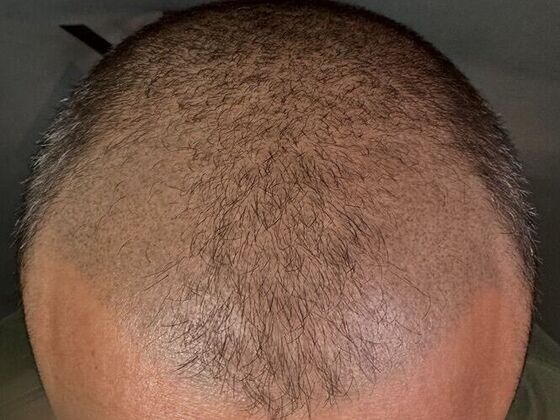 FUE Hair Restoration: Case 42 - Before