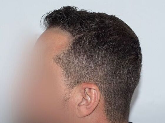 FUE Hair Restoration: Case 42 - After