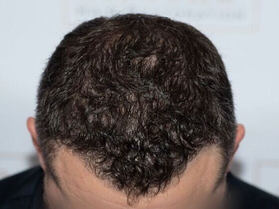 FUE Hair Restoration: Case 42 - After