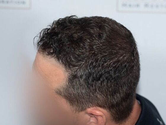 FUE Hair Restoration: Case 42 - After