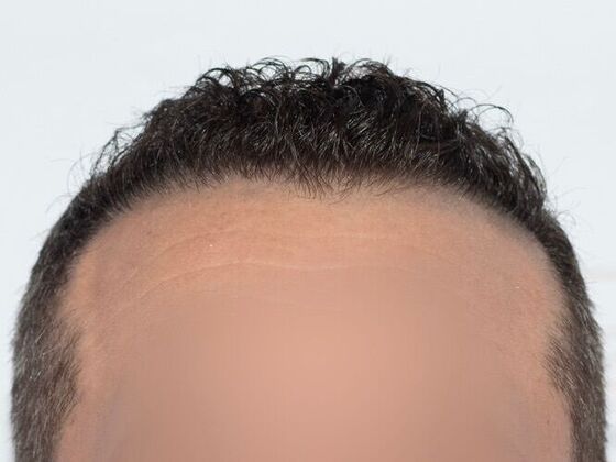 FUE Hair Restoration: Case 42 - After