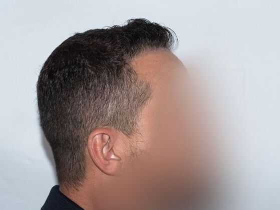 FUE Hair Restoration: Case 42 - After