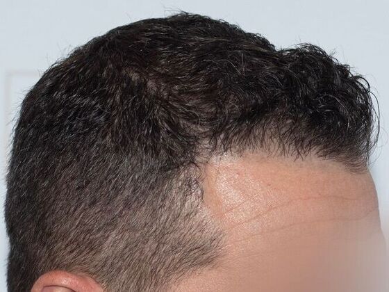 FUE Hair Restoration: Case 42 - After