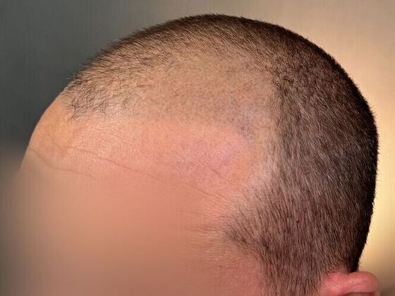 FUE Hair Restoration: Case 42 - Before
