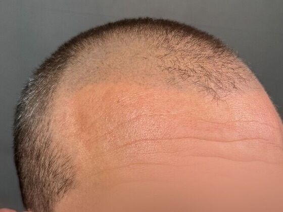 FUE Hair Restoration: Case 42 - Before