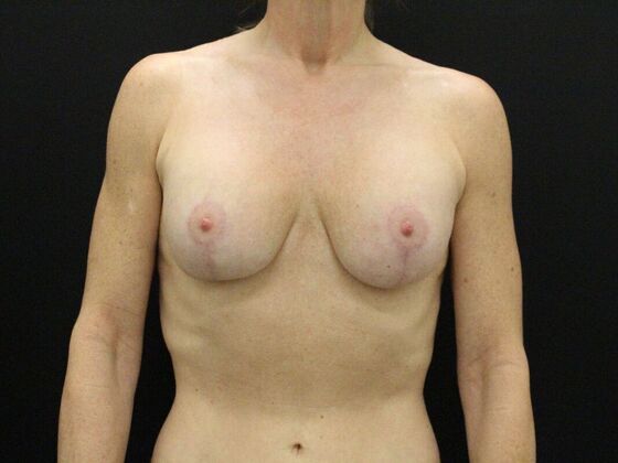 Breast Lift & Breast Lift Augmentation Case 47 - After
