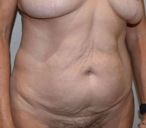Tummy Tuck (Abdominoplasty): Case 506 - Before
