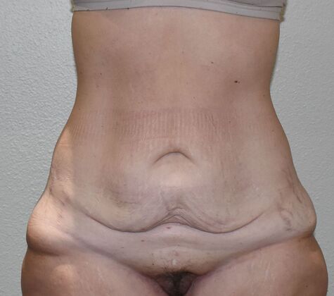 Tummy Tuck (Abdominoplasty): Case 508 - Before