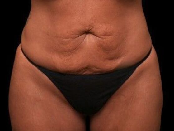 Tummy Tuck with Contouring Case 4 - Before