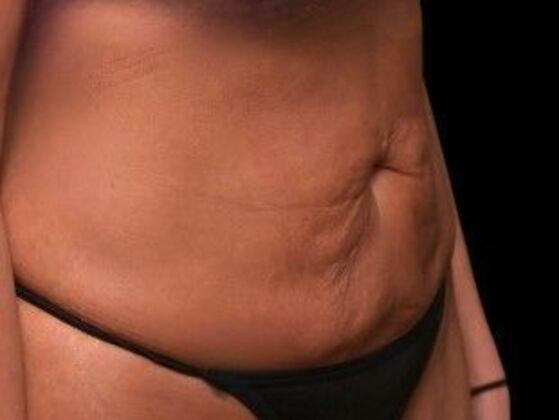 Tummy Tuck with Contouring: Case 4 - Before