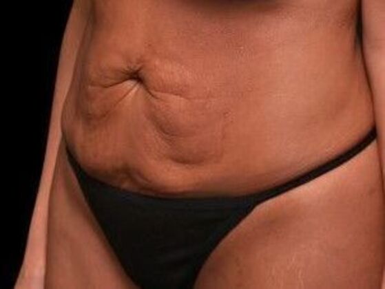 Tummy Tuck with Contouring: Case 4 - Before