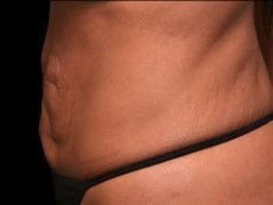Tummy Tuck with Contouring: Case 4 - Before