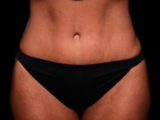 Tummy Tuck with Contouring Case 4 - After
