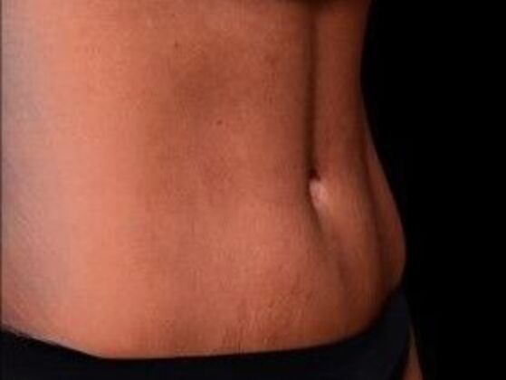 Tummy Tuck with Contouring: Case 4 - After