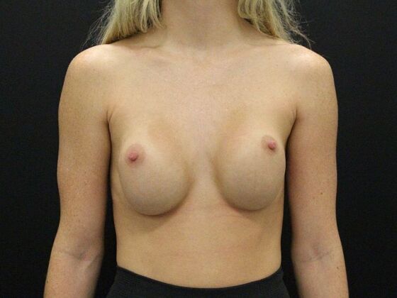 Breast Revision Case 13 - Before