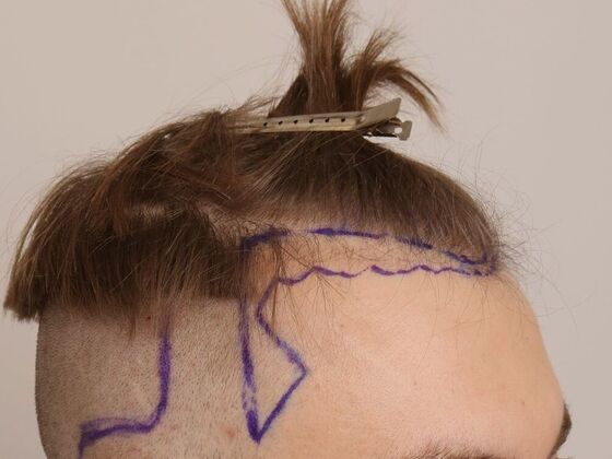 Male Before And After Hair Transplant Photos Hairline FUE (18) - Before