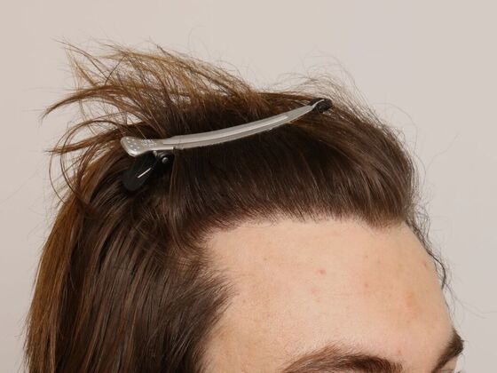 Male Before And After Hair Transplant Photos Hairline FUE (18) - After