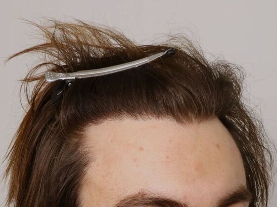 Hair Transplant - Male: Hairline FUE - Case 18 - After male FUE hair transplant