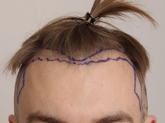 Hair Transplant - Male: Hairline FUE - Case 18 - Before FUE hair transplant