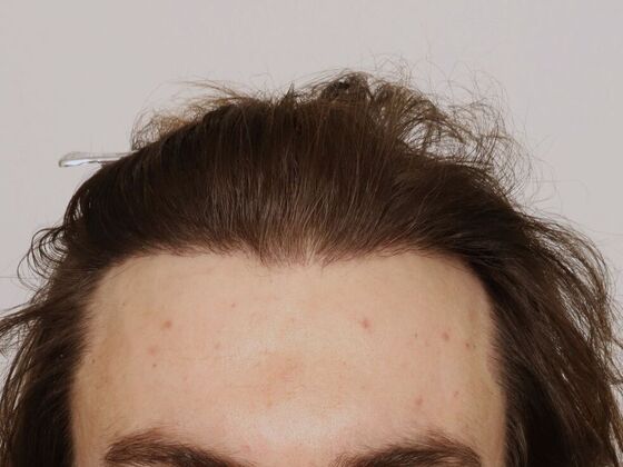 Hair Transplant - Male: Hairline FUE - Case 18 - After male FUE hair transplant
