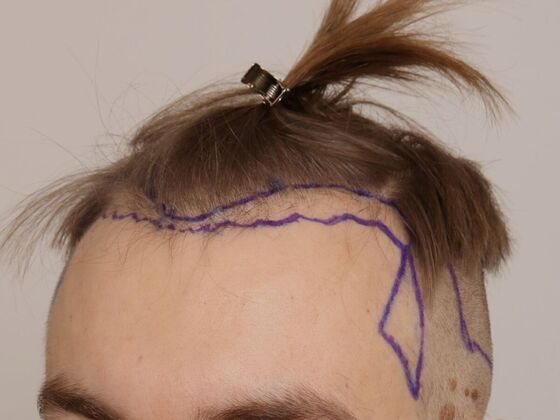 Hair Transplant - Male: Hairline FUE - Case 18 - Before FUE hair transplant