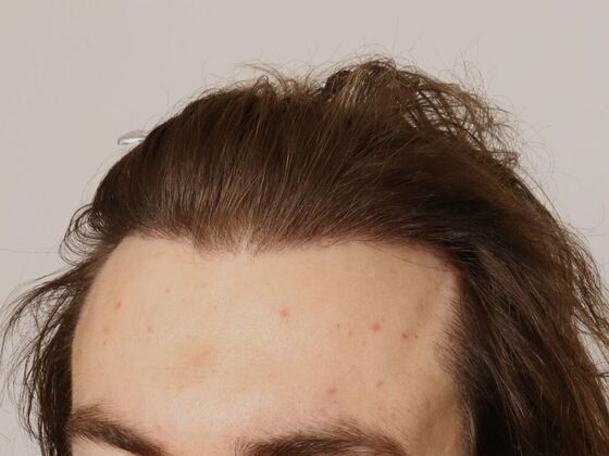 Hair Transplant - Male: Hairline FUE - Case 18 - After male FUE hair transplant