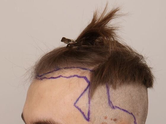 Hair Transplant - Male: Hairline FUE - Case 18 - Before FUE hair transplant