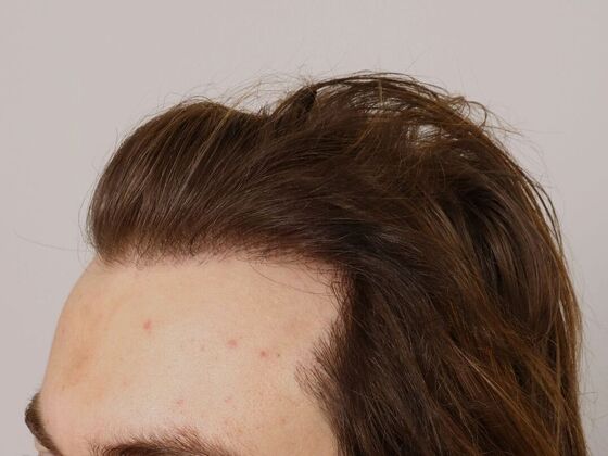 Hair Transplant - Male: Hairline FUE - Case 18 - After male FUE hair transplant