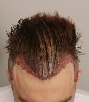 Hair Transplant - Male: Hairline FUE - Case 18 - Post-op FUE