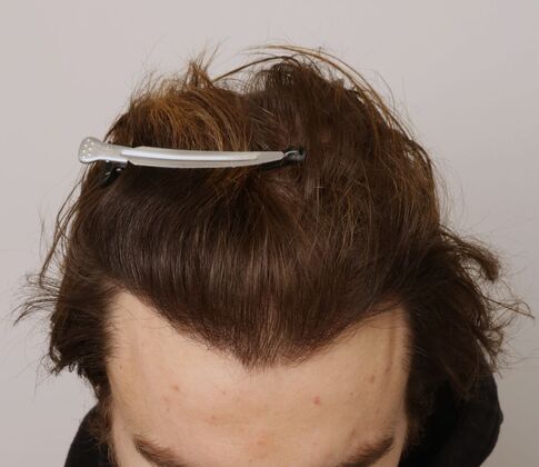 Hair Transplant - Male: Hairline FUE - Case 18 - After male FUE hair transplant