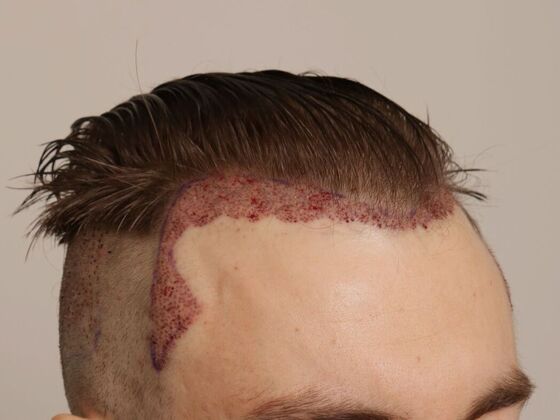Hair Transplant - Male: Hairline FUE - Case 18 - Post-op FUE hair transplant