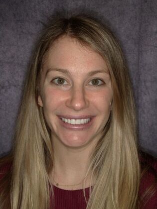 Our Smile Transformations Emily - After