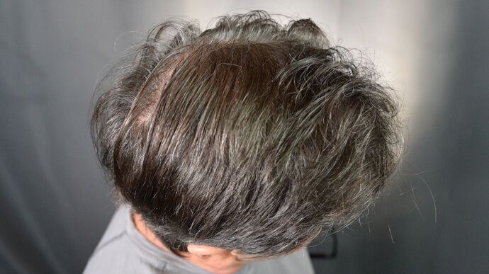 FUT Hair Restoration: Case 46 - After