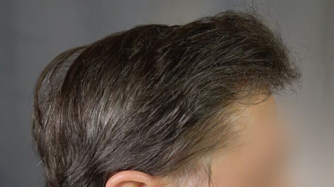 FUT Hair Restoration: Case 46 - After