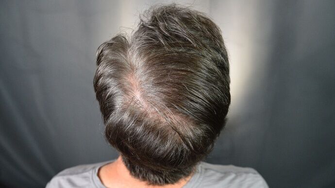 FUT Hair Restoration: Case 46 - After