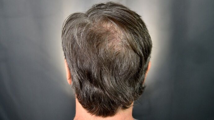 FUT Hair Restoration: Case 46 - Before