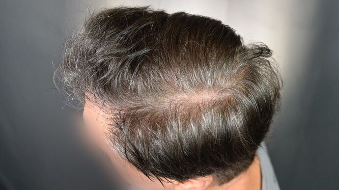 FUT Hair Restoration: Case 46 - After