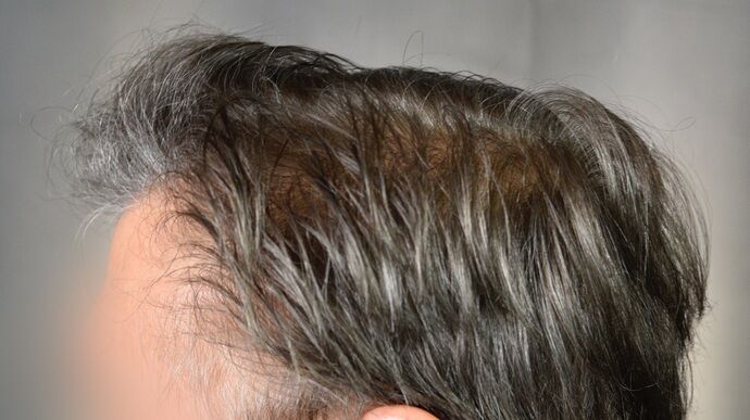 FUT Hair Restoration: Case 46 - After