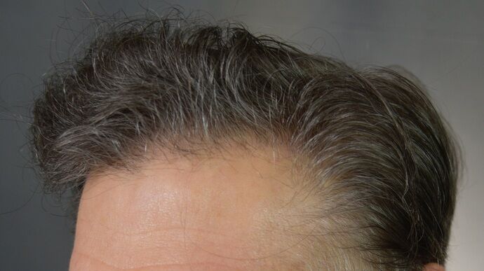 FUT Hair Restoration: Case 46 - After