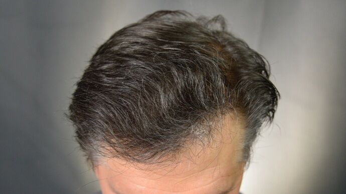 FUT Hair Restoration: Case 46 - After