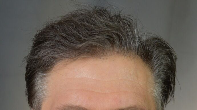 FUT Hair Restoration Case 46 - After