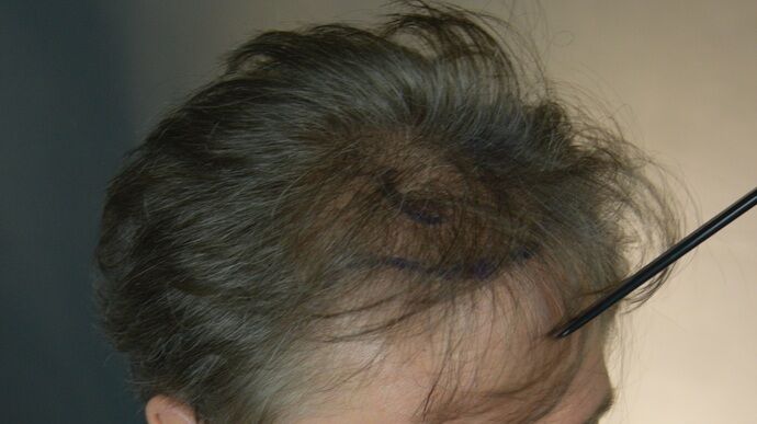 FUT Hair Restoration: Case 46 - Before