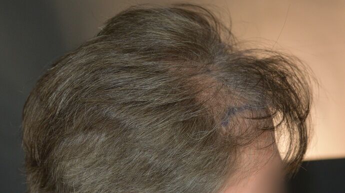 FUT Hair Restoration: Case 46 - Before